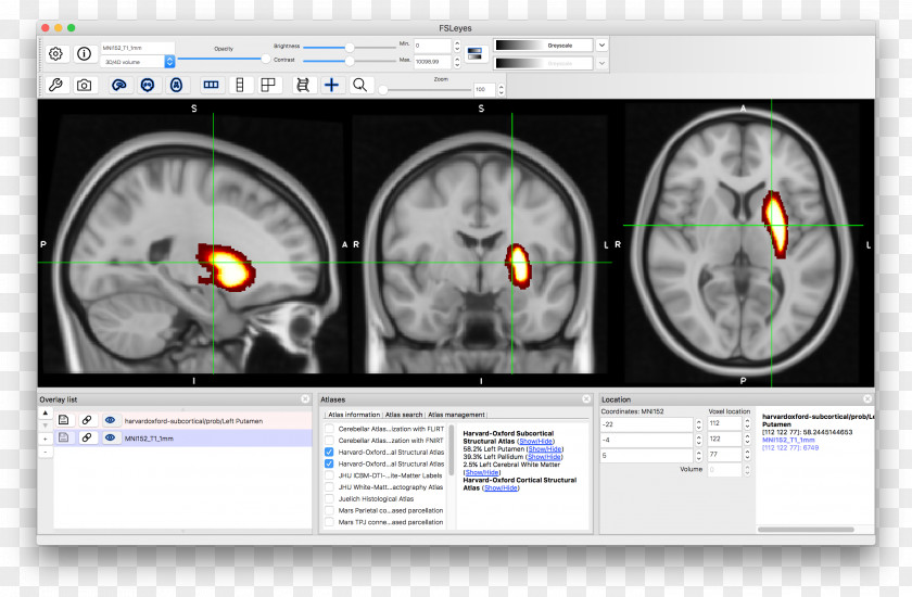 Brain Computed Tomography Neuroimaging PNG
