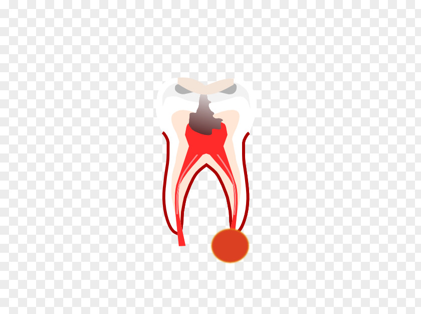 Crown Dentistry Root Canal Tooth Dentures PNG