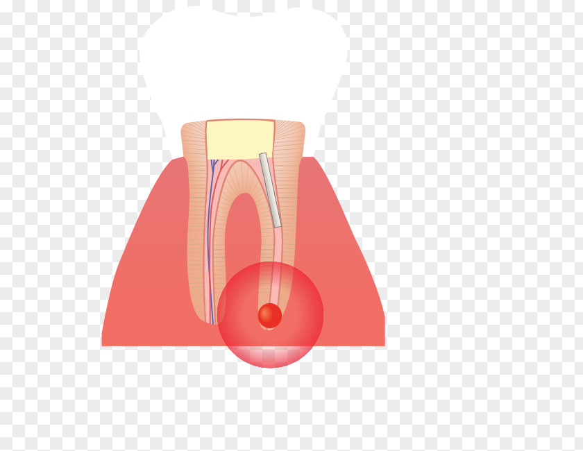Root Canal Infection Tooth Poster PNG