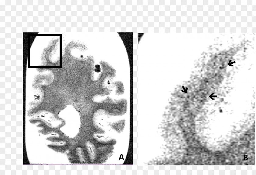 Alzheimer's Disease Occipital Lobe Lobes Of The Brain Temporal Cerebral Cortex Parietal PNG