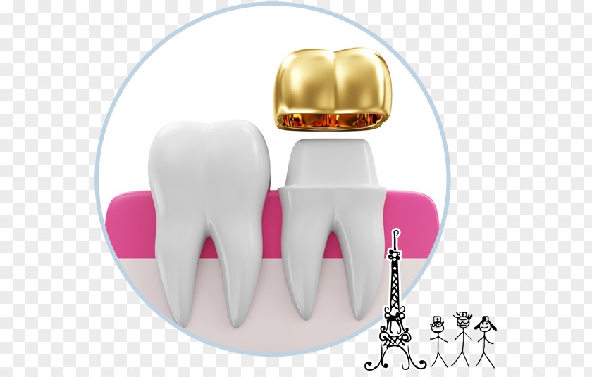 Crown Tooth Dentistry Prosthodontics Dental Implant PNG