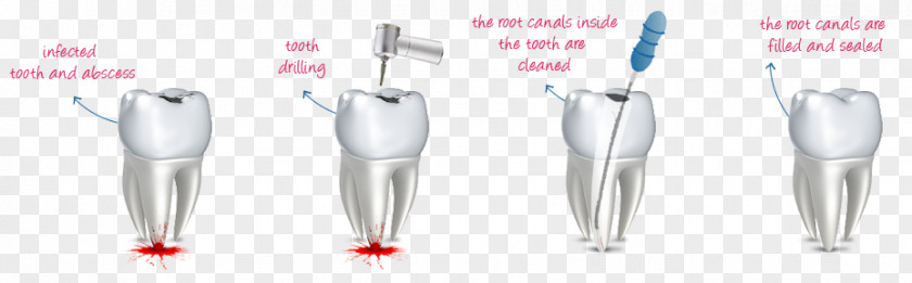 Decayed Tooth Dental Mint Endodontic Therapy Root Canal Human PNG