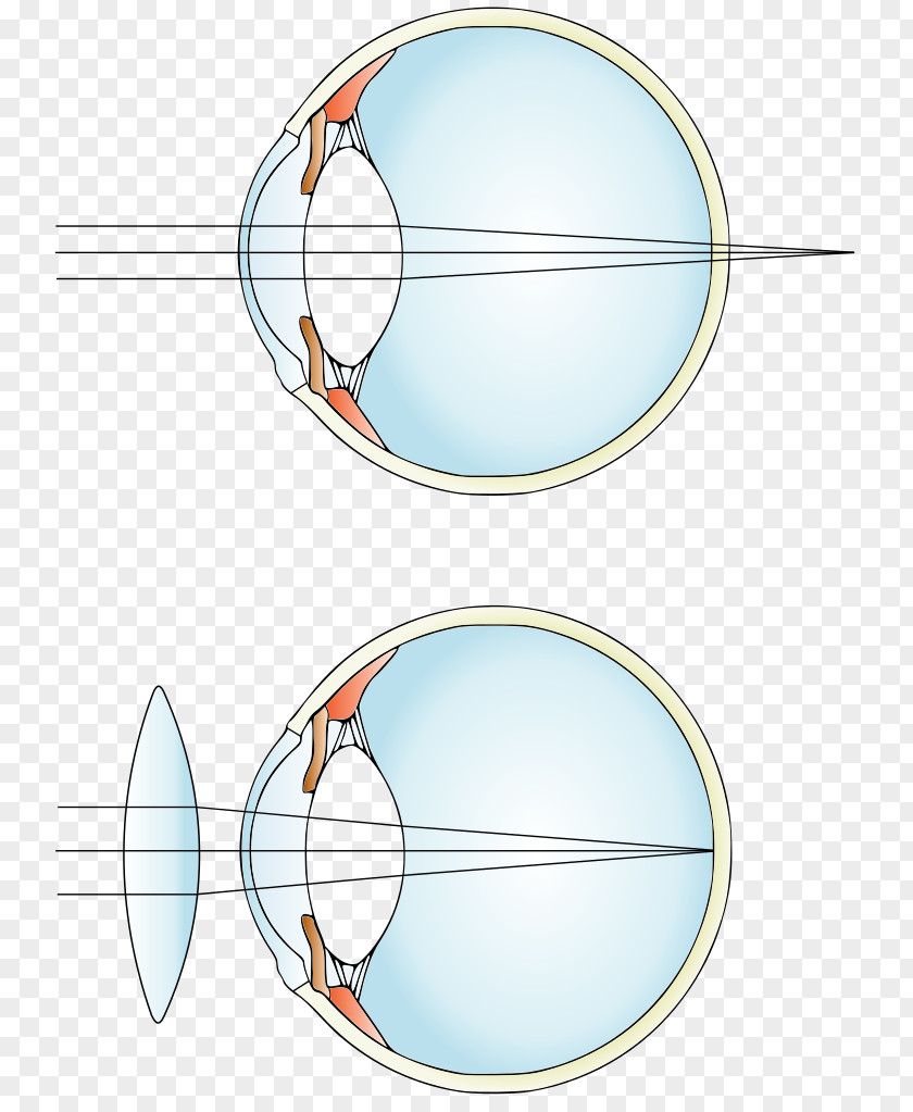 Eye Far-sightedness Near-sightedness Corrective Lens PNG