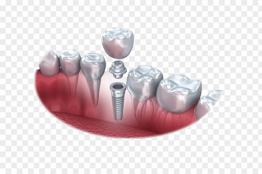 Dental Anatomy Of Teeth Implant Dentistry Tooth PNG