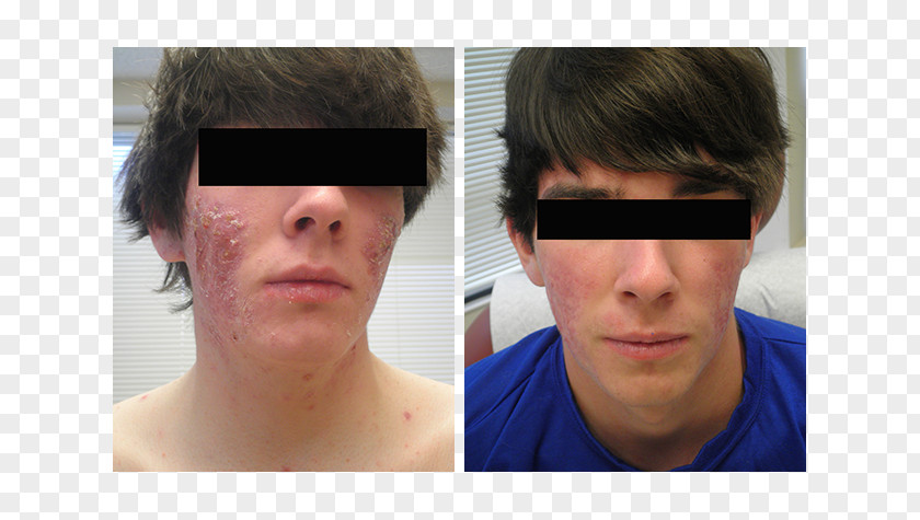 Month Of Fasting Dermatology Cheek Isotretinoin Therapy Laser PNG