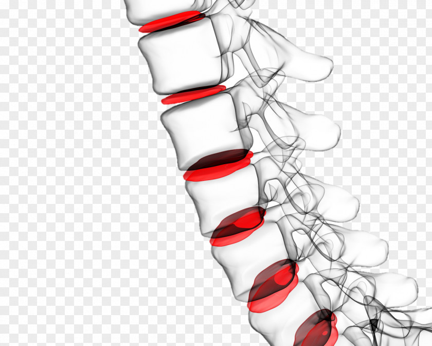 Fish Vivid Vision Vertebral Column Low Back Pain Spinal Disc Herniation Human PNG