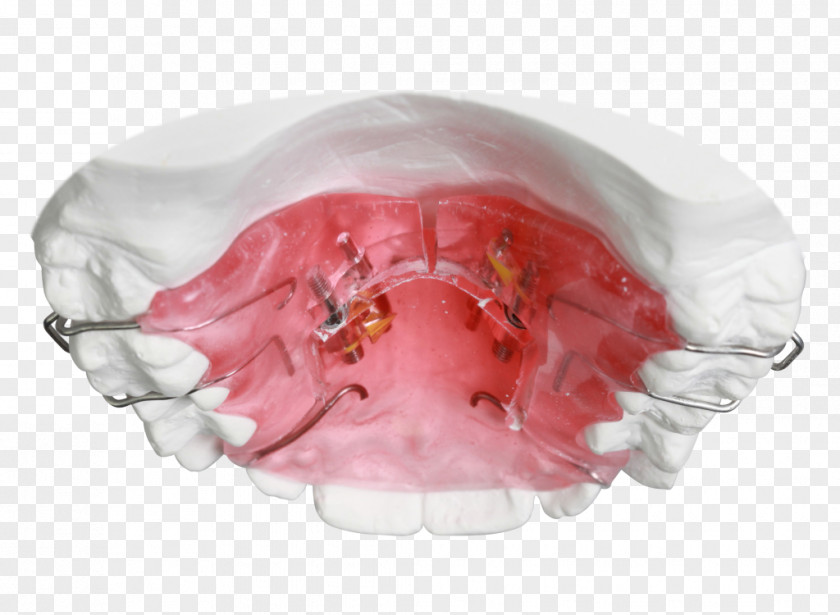 Orthodontics Sagittal Plane Orthodontic Technology Jaw Retainer PNG