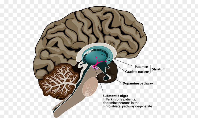 Brain Parkinson's Disease Deep Stimulation Neuroimaging PNG