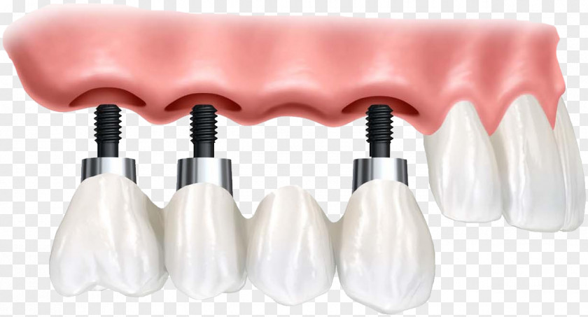Dental Implant Dentistry Dentures Tooth Loss PNG