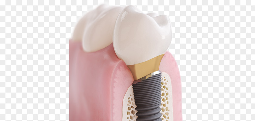 Crown Dental Implant Cosmetic Dentistry Tooth PNG