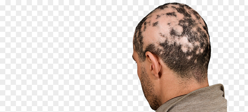 Hair Alopecia Areata Non Scarring Loss Pattern PNG