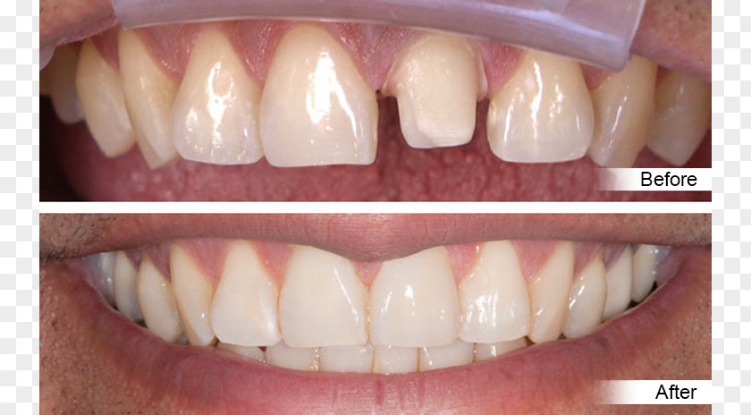 Crown Tooth Dentistry Dental Restoration PNG