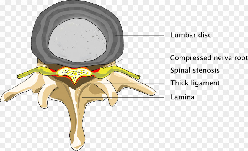 Spinal Back Disc Herniation Cord Stenosis Pain PNG