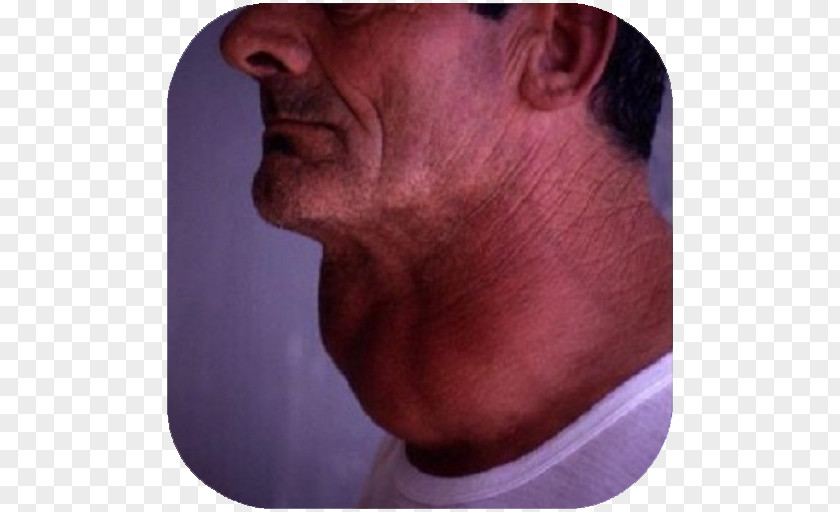 The Thyroid Gland Disease Goitre PNG