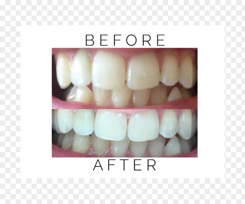 Oil Pulling Tooth Whitening Coconut PNG