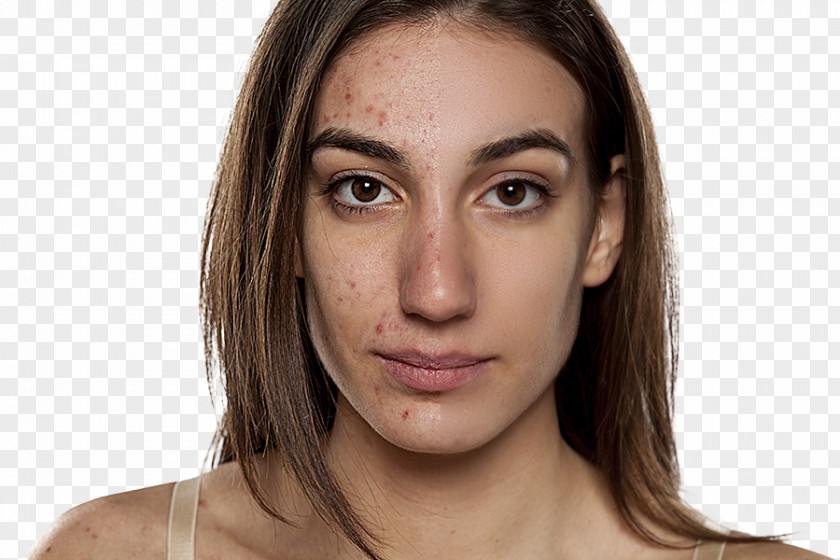 Scar Acne Dermatology Pimple Cutaneous Condition PNG