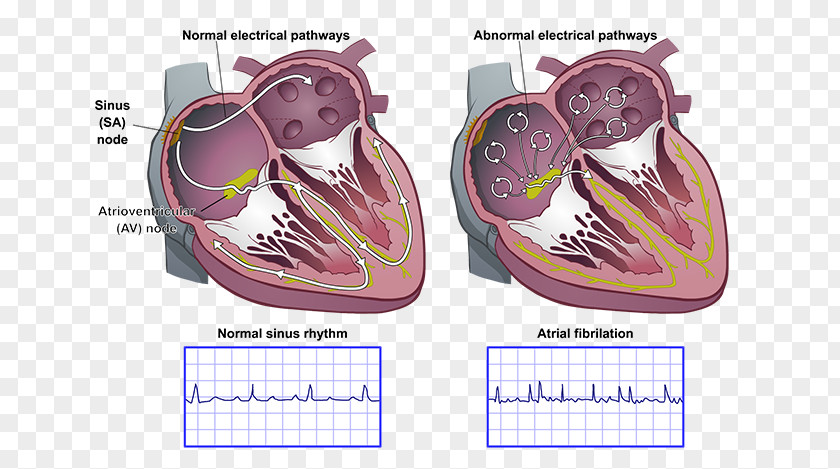 Heart Arrhythmia AV Nodal Reentrant Tachycardia Atrial Fibrillation Sinoatrial Node Atrium PNG