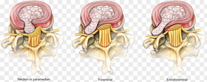 Lumbar Disc Herniation Spinal Surgery Disease Discectomy PNG