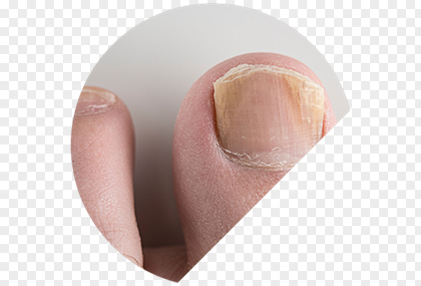 Fingernail Foot Onychomycosis The Nail Fungal Infection PNG