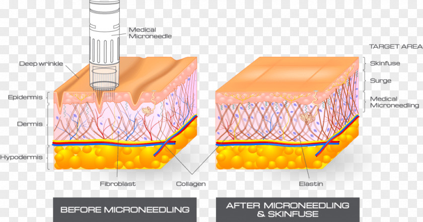 Collagen Induction Therapy Human Skin Care PNG