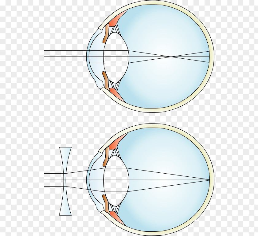 Defocused Near-sightedness Hypermetropia Corrective Lens Refractive Error PNG