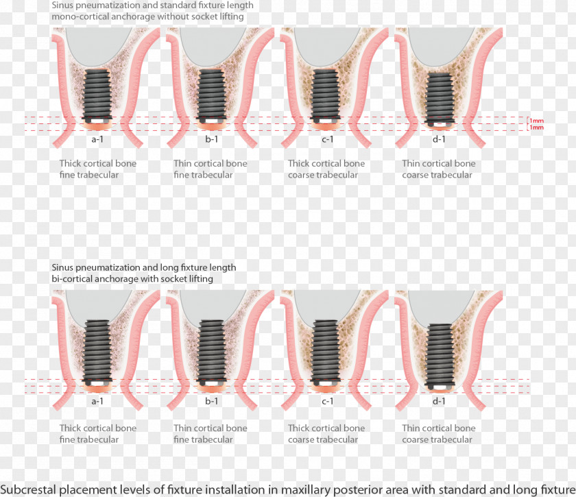 Pattern Lock Dental Implant Maxillary Sinus Tooth Bone PNG