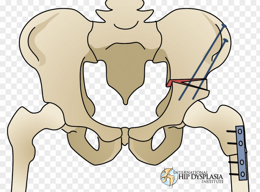 Cicatriz Osteotomy Hip Dysplasia Surgery Therapy PNG