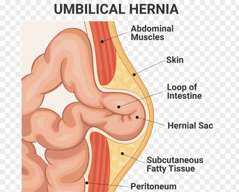 Umbilical Hernia Repair Inguinal Surgery PNG
