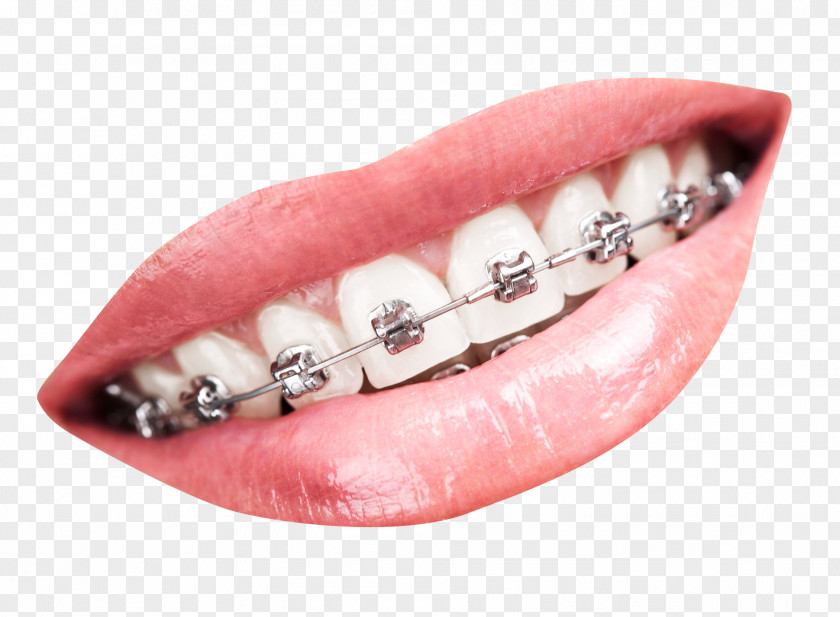 Teeth With Braces Tooth Dental Dentistry PNG