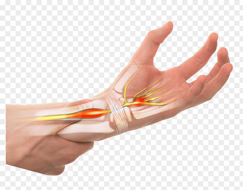 Hand Thumb Carpal Tunnel Syndrome Symptom PNG