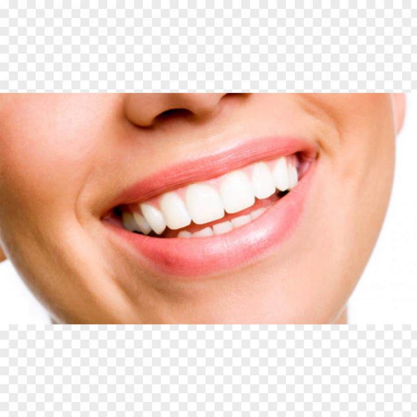 Crown Tooth Whitening Cosmetic Dentistry Veneer PNG
