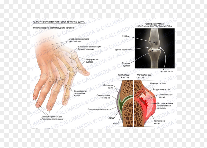 Hand Grave Rheumatoid Arthritis Chronic Childhood Disease Rheumatism PNG