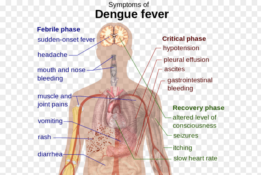 Dengue Virus Viral Hemorrhagic Fever Symptom PNG