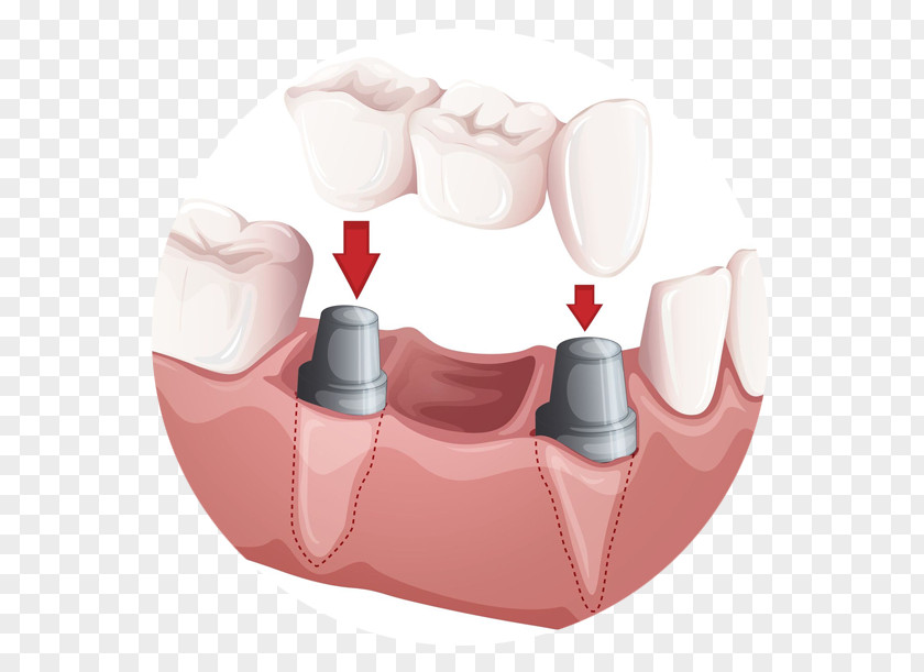 Implants Bridge Dentistry Crown Dental Implant PNG