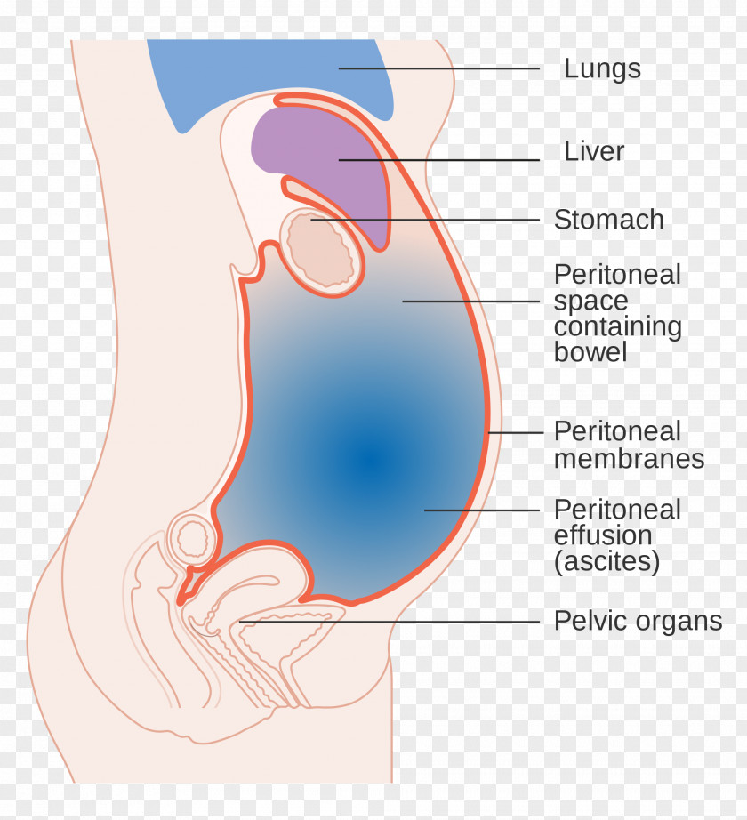 Hepatomegaly Symptom Liver Ascites Medical Sign PNG