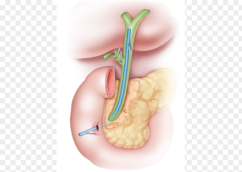 Pig Tail Stenting Common Bile Duct Gallbladder PNG