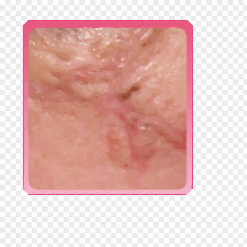 Surgical Scars Skin Pink PNG