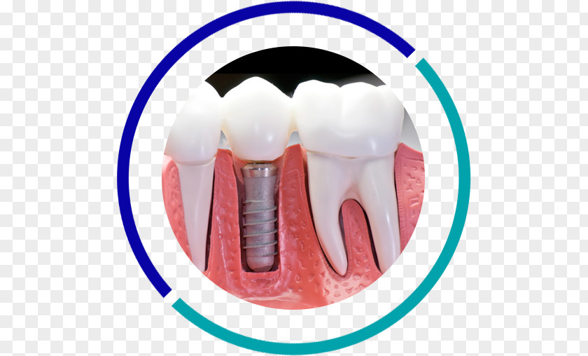 Bridge Dental Implant Dentistry Tooth PNG