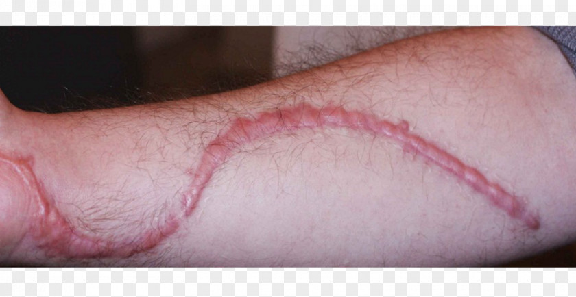 Scar Hypertrophic Skin Hypertrophy Thumb PNG