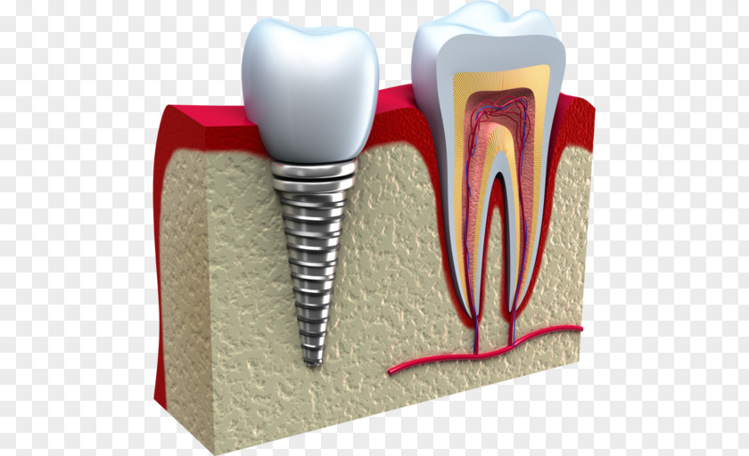 Dental Implant Cosmetic Dentistry PNG