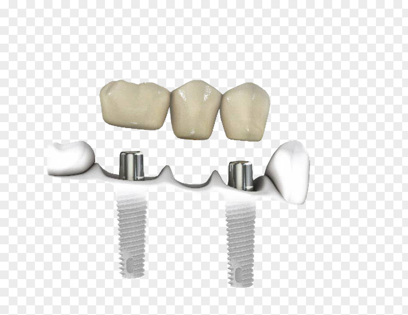 Dental Implants Tooth Dentistry Implant PNG