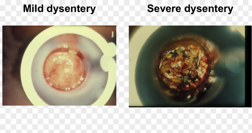 Mucus Human Feces Dysentery Diarrhea Blood In Stool Test PNG
