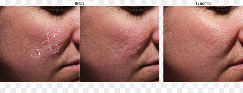 Scar Cheek Acne Injectable Filler Therapy PNG