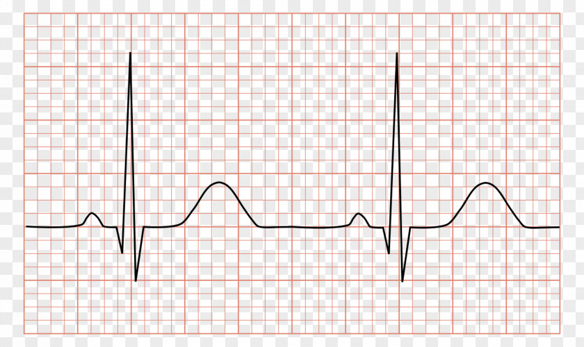 Heart Electrocardiography QRS Complex Sinus Rhythm Arrhythmia PNG