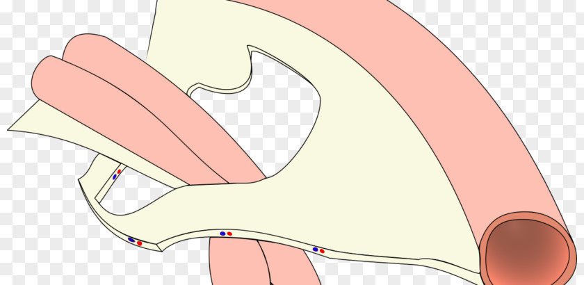 Internal Hernia Large Intestine Small Bowel Obstruction PNG