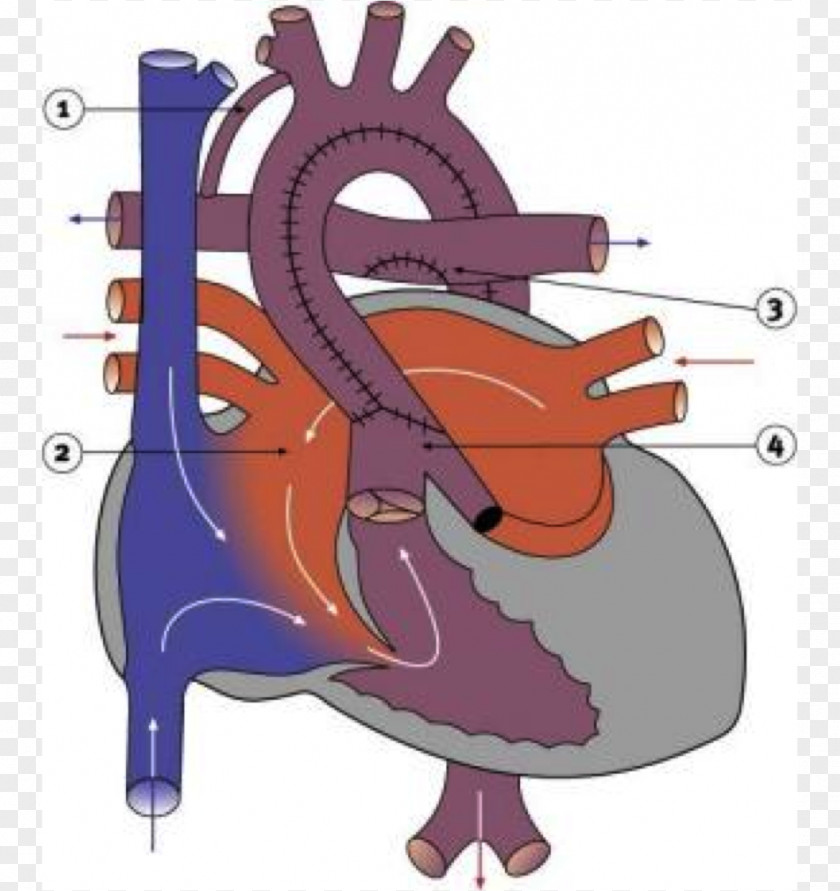 Heart Coarctation Of The Aorta Ductus Arteriosus Congenital Defect Ventricular Septal PNG