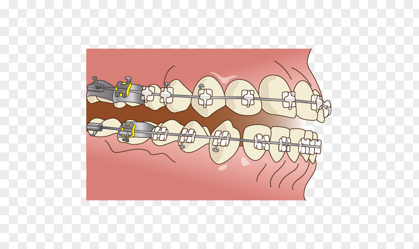 Dental Braces Dentistry 矯正歯科 PNG
