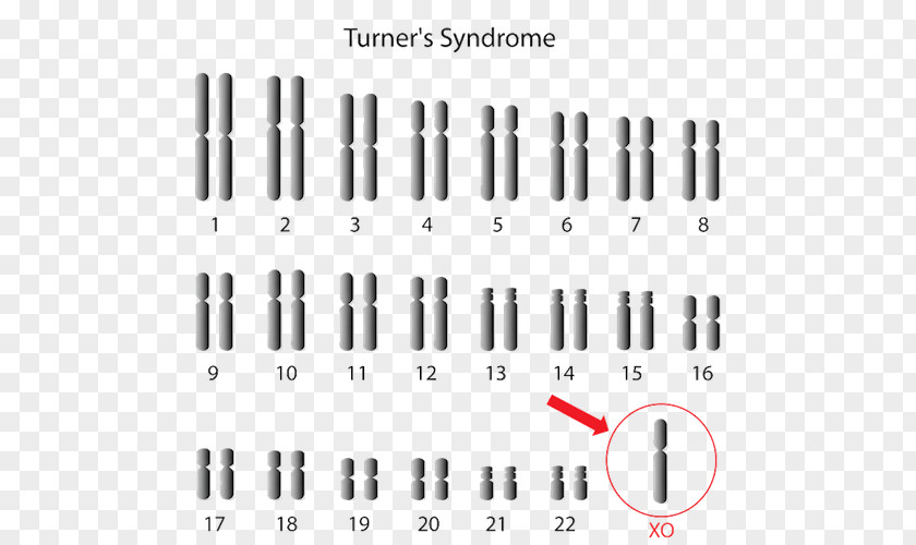 Edwards Syndrome Monosomy Turner X Chromosome Triple PNG