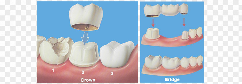 Bridge Crown Dentistry Dental Restoration PNG