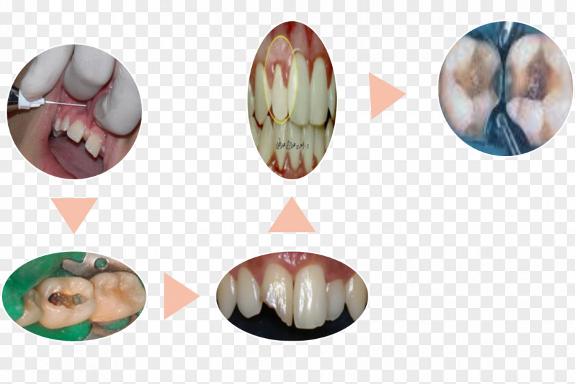 Endodoncia Endodontic Therapy Root Canal Dentistry Ya Lo Sabemos Pulp PNG